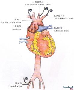 主動脈瘤