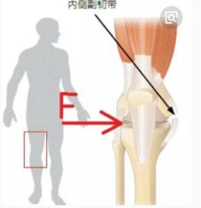 膝關節內側副韌帶損傷