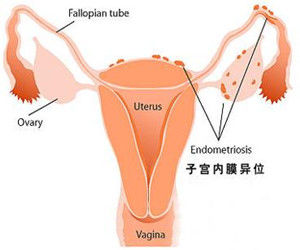 子宮內膜異位性不孕