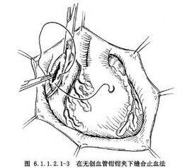 心破裂修復術