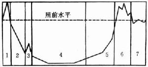 腸型急性放射病