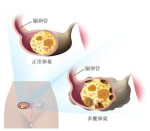 多囊卵巢