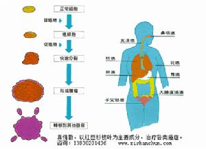 癌症復發