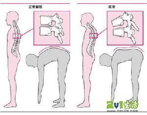 原發骨骺骨軟骨病