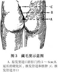 藏毛性疾病