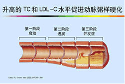 冠狀動脈粥樣硬化 