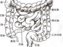 乙狀結腸癌