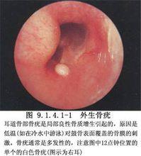 外耳道良性腫瘤切除術