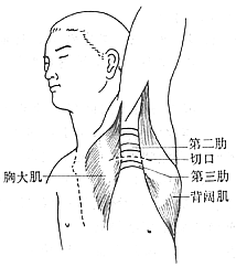 胸廓出口綜合症