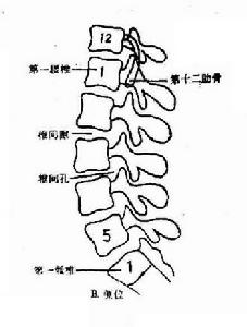 腰椎間盤突出