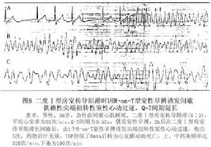 間歇依賴型尖端扭轉型室性心動過速