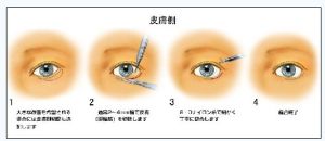 日本眼瞼下至術手術過程圖解