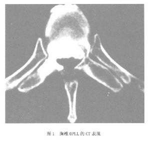 胸椎後縱韌帶骨化症