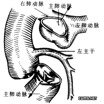 肺動脈狹窄