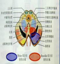 weber綜合徵