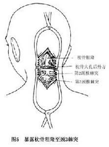 （圖）枕頸