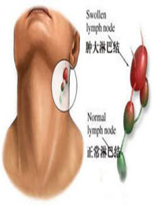 扁桃體惡性腫瘤