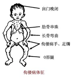 先天性脊柱側凸