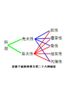 先天性肌性斜頸