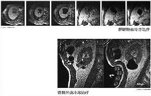 前列腺腫瘤