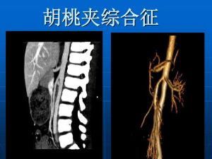 胡桃夾綜合徵