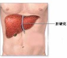 原發性肝內硬化綜合徵