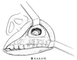 上頜竇根治術