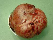 9斤巨大腎母細胞瘤