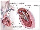 退行性瓣膜性心臟病