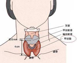 甲狀腺切除術