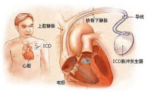 小兒房室傳導阻滯