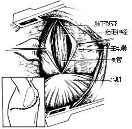 經膈肌肋間疝