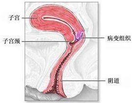 高危型人乳頭瘤病毒