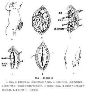 臍膨出 圖4