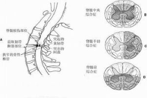 馬尾神經損傷