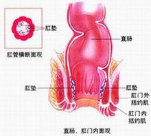 痔核