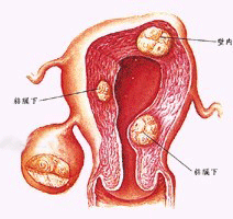 納博特囊腫