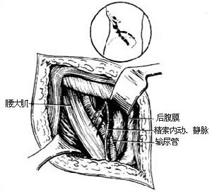 圖1:顯露上段輸尿管(示意圖)