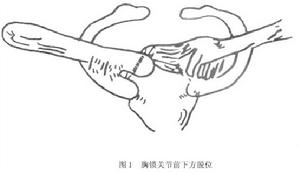 胸鎖關節脫位