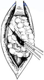 缺血性腸絞痛