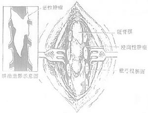 椎管內轉移性腫瘤