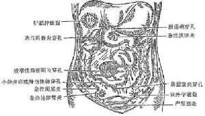 急性腹膜炎