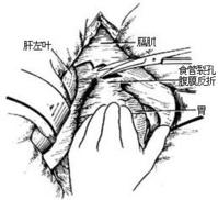 示意圖9:將肝拉開，切開腹