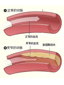 主動脈硬化