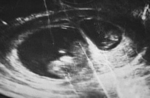 朱麗婭子宮的超音波掃描圖