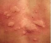皮膚蕁麻疹