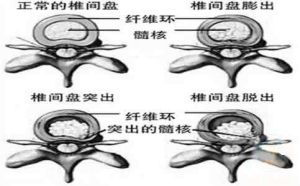 腰椎間盤突出症自我調理