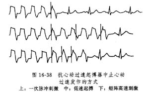 異位性心動過速