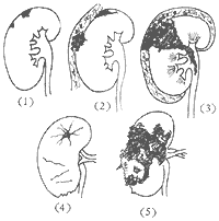 重金屬中毒性腎病