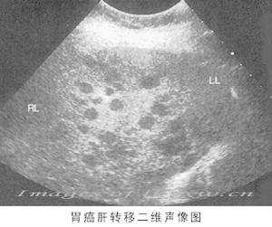 繼發性腫瘤